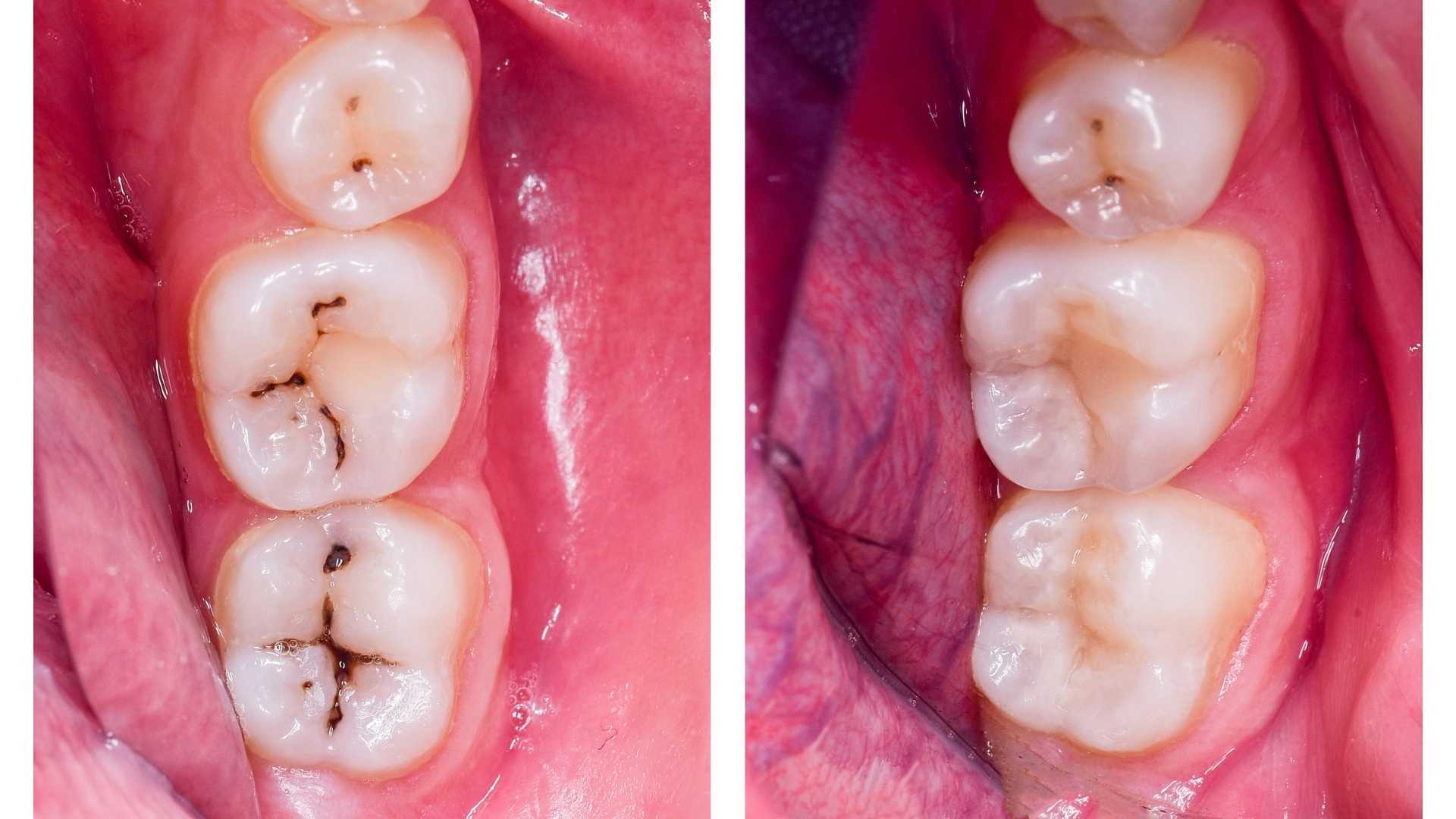 Composite fillings may be more difficult to set than porcelain ones.